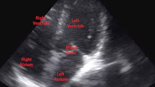 Echocardiogram of Premature Ventricular Contraction  Loop [upl. by Fairfield557]