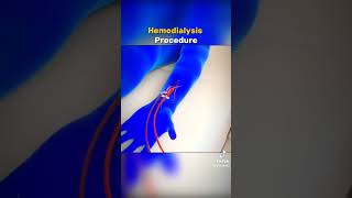 Hemodialysis procedure cardiacnurse medicalprofessional 100view doctor [upl. by Nalek]