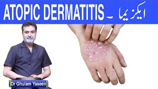 ECZEMA CAUSES SYMPTOMS TREATMENT ایکزیما علامات وجوھات علاج [upl. by Alphonsine408]