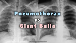 Pneumothorax vs Giant Bulla in Chest X Ray Part 6 [upl. by Portwin]