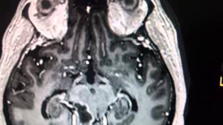 HAEMOSIDERIN LEVEL MARK INTRACAVITARY BLEEDING IN ADULT ASTROCYTOMA CEREBELLAR [upl. by Lawton897]