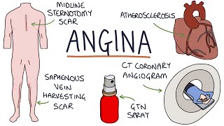 Understanding Angina Visual Explanation for Students [upl. by Harlie]