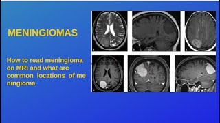 Case 1 Cerebellopontine angle Meningioma [upl. by Imak]