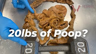 How Much Poop Is Stored in Your Colon [upl. by Sink]