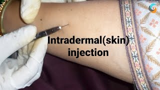 intradermal or skin injection [upl. by Tabber]