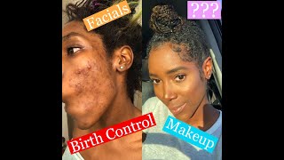 How I cured my SEVERE cystic acne  Skincare Routine 2019 [upl. by Christabelle]