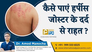 कैसे पाएं हर्पीस जोस्टर के दर्द से राहत How to get relief from Herpes Zoster pain Dr Amod Manocha [upl. by Trebleda]