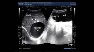 Hepatic Hydatid Cyst [upl. by Lledrev4]