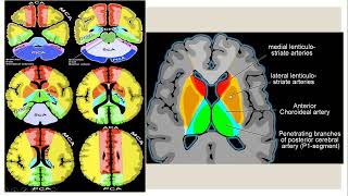 Neuroradiology case presentation session 2 [upl. by Einwahs]