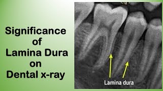 Alveolar bone anatomy Lamina Dura Radiographic Features and Clinical Importance [upl. by Fritz]