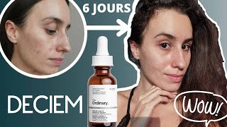 JE TESTE LE NOUVEAU SÉRUM À LACIDE SALICYLIQUE DE THE ORDINARY COMMENT LUTILISER A QUOI SERTIL [upl. by Oiramej820]