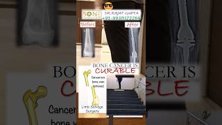 Ewing Sarcoma bonecancer knee patient walk after surgeryDr Rajat Gupta bonecancerclinic [upl. by Manwell]