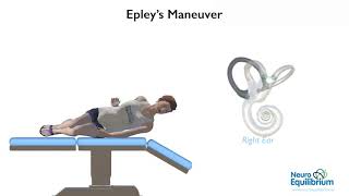 Epley Maneuver A Step by Step Guide to Treat BPPV Vertigo [upl. by Llerrom]