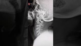 X ray c spine vairalvideo anatomy radiological [upl. by Tatiania]