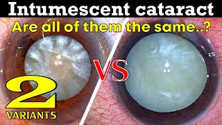 Intumescent Cataracts Are all of them the same  Dr Deepak Megur [upl. by Elimay]