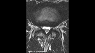 Adhesive Arachnoiditis An Advanced Lecture [upl. by Yulma]