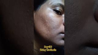 Day30 Using Tretinoin 0025 Cream viralvideo tretinoin skincare shorts youtubeshorts [upl. by Avrenim]