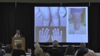 Inflammatory Arthritis Types and Treatments [upl. by Aivato907]