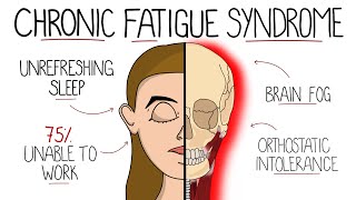 Myalgic Encephalomyelitis Chronic Fatigue Syndrome  Includes Criteria amp Treatment [upl. by Derry645]