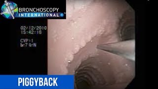 Flexible Bronchoscopy Basic Techniques 8  TBNA Piggyback [upl. by Erick]