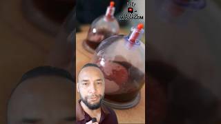 VENTOSATERAPIA COM SANGRIA  DicasdeMassagem com Maiquel Severo [upl. by Snebur]