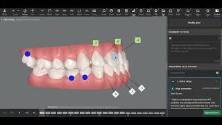 Class III Invisalign [upl. by Ycram]