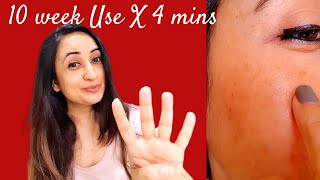 Be Minimalist Tranexamic AcidSerum 10 WEEK Live Result Mini Product Review 4Min Review [upl. by Malanie412]