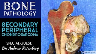 Secondary Peripheral Chondrosarcoma from OsteochondromaExostosis Bone Pathology with Dr Rosenberg [upl. by Froemming266]