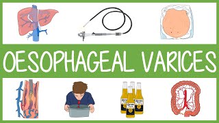 Oesophageal Varices [upl. by Rehposirhc189]