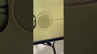 Intracytoplasmic Sperm Injection ICSI [upl. by Godard]