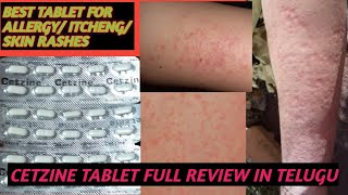 BEST TABLET FOR ALLERGY AND SKIN RASHES AND ITCHINGCETZINE TABLET USES DOSE FULL REVIEW IN TELUGU [upl. by Grassi46]