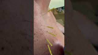 Supraspinatus Tendonitis wPartial Tear treated by Dry Needling [upl. by Ofilia]