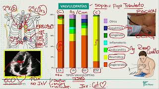 Valvulopatias Estenosis Aortica Insuf Aortica Estenosis Mitral Insuficiencia [upl. by Auguste152]