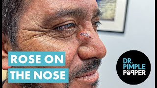 Dr Pimple Popper Opens A Rose on the Nose [upl. by Anauqed]