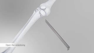 AO HTO Tomofix anatomical DePuy Synthes [upl. by Allenrad]