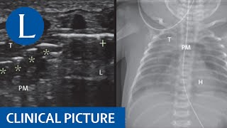 Pneumomediastinum in the neonate [upl. by Mode]