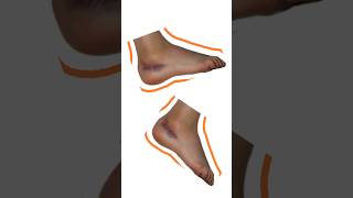 Ankle Ligament tear treatment  Grade 3 Sprain management  viral shorts  I am Physiotherapist [upl. by Oidiple470]