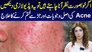 Understanding Acne Causes and Effective Treatments  Dr Sahar Chawla [upl. by Mildrid]