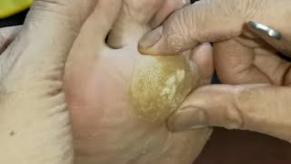 Removing an Extremely Large Callus on the Bottom of the Foot【Athlete’s foot pedicure】 [upl. by Fionna502]