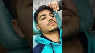 TCA CROSS for acne scars  GRACE CLINIC Dehradun  acne scar treatment Pragyanjal step1 [upl. by Pirali]