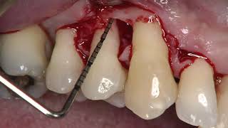 Single Flap Approach in combination with Enamel Matrix Derivative Straumann® Emdogain® [upl. by Llenrag]