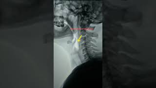 Movement of epiglottis in xray [upl. by Zerat]