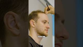 The game plan hair hairtransplant hairtransformation shaveitoff buzzcut hairline [upl. by Ree600]