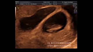 How is an 8 weeks dichorionic diamniotic twin pregnancy seen on ultrasound Possible lambda sign [upl. by Eilloh]