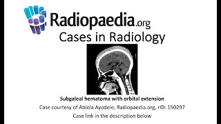 Subgaleal hematoma with orbital extension Radiopaediaorg Cases in Radiology [upl. by Kore]