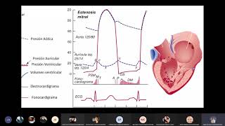 Estenosis mitral [upl. by Nimajeb]