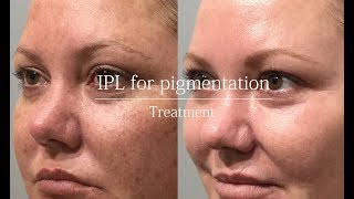 IPL for pigmentation  treatment video [upl. by Nossaj]