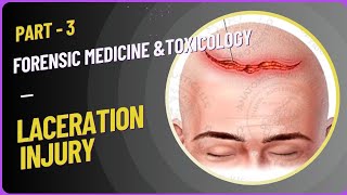 Laceration Injury types amp medicolegal importance  Mechanical Injury  Forensic Medicine  part3 [upl. by Lanna]