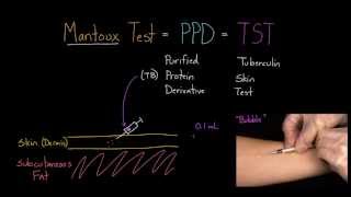 Mantoux Test aka PPD or TST [upl. by Roper442]