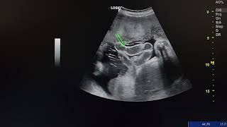 ultrasound case shows a fetus with gastroschisis [upl. by Chatav301]